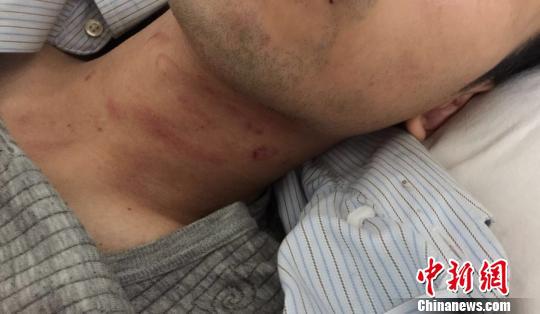 图为受伤的谢某。 钟欣 摄